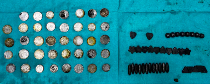 $!Las monedas e imanes encontrados en el intestino y estómago del joven.