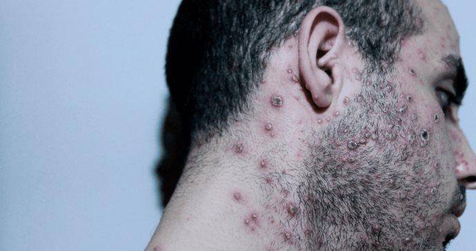 Referencial. ADN viral se puede detectar con frecuencia en diferentes muestras clínicas de pacientes infectados por la viruela del mono, como saliva y semen.