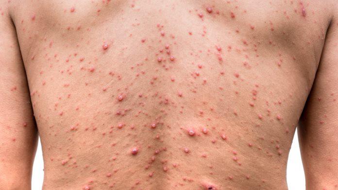 Casos de viruela del mono ascienden a 51 en Ecuador