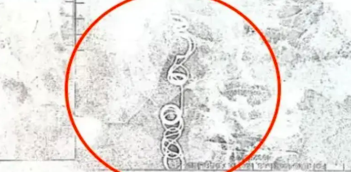 $!La radiografía que muestra a la aguja con el hilo.