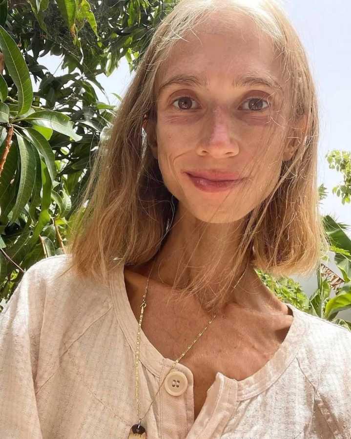 $!La joven de 27 años pesaba apenas 22 kilos y presentaba síntomas de malnutrición avanzada.