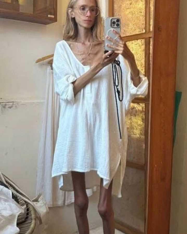 $!Su autopsia reveló deficiencia grave de albúmina y osteoporosis.