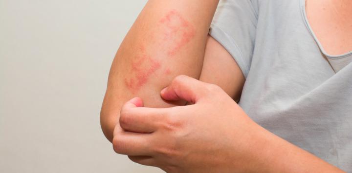 Enfermedades de piel como la psoriasis provocan fuertes impactos emocionales
