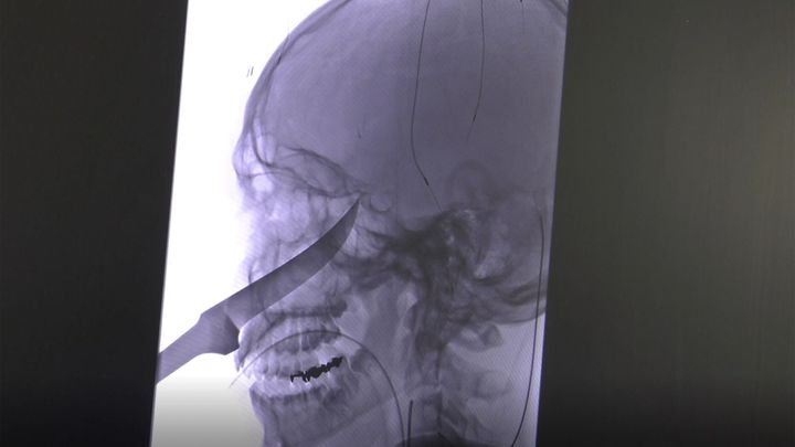 Adolescente sobrevive tras clavarse un cuchillo de 25 cm en el rostro