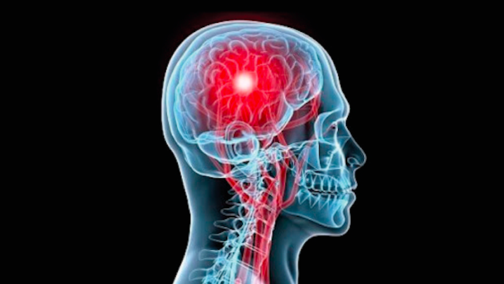Día mundial del Accidente Cerebrovascular: la importancia de su prevención y tratamiento