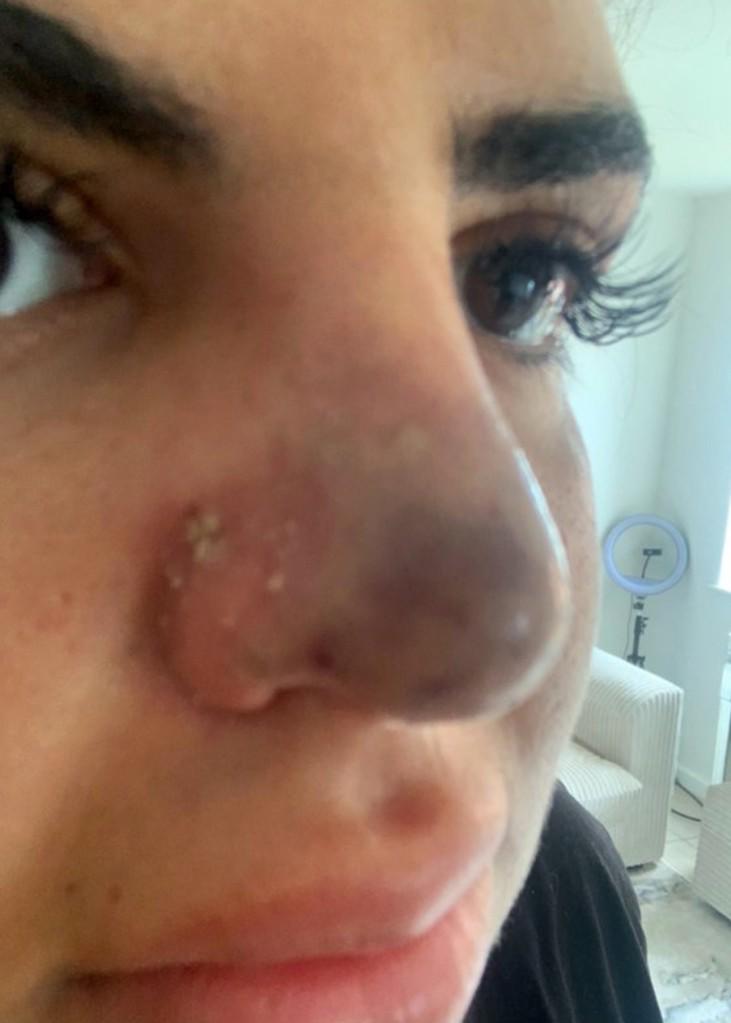 $!Mujer casi pierde su nariz y labios tras someterse a tratamiento estético