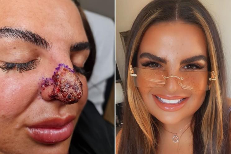 $!Mujer casi pierde su nariz y labios tras someterse a tratamiento estético