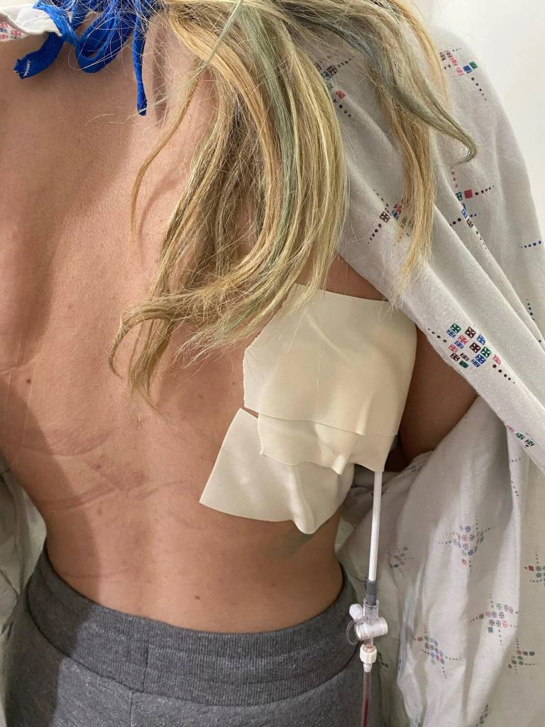 $!Fotografía de la espalda de Karlee durante una de sus hospitalizaciones por colapsos pulmonares.