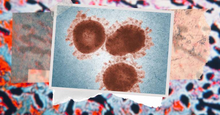 $!La hemofilia es un trastorno hemorrágico en el que la sangre no coagula correctamente debido a la falta de proteínas llamadas factores de coagulación.