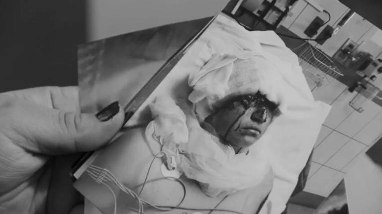 $!Laura perdió todo su cuero cabelludo durante practicas preprofesionales en 2015.