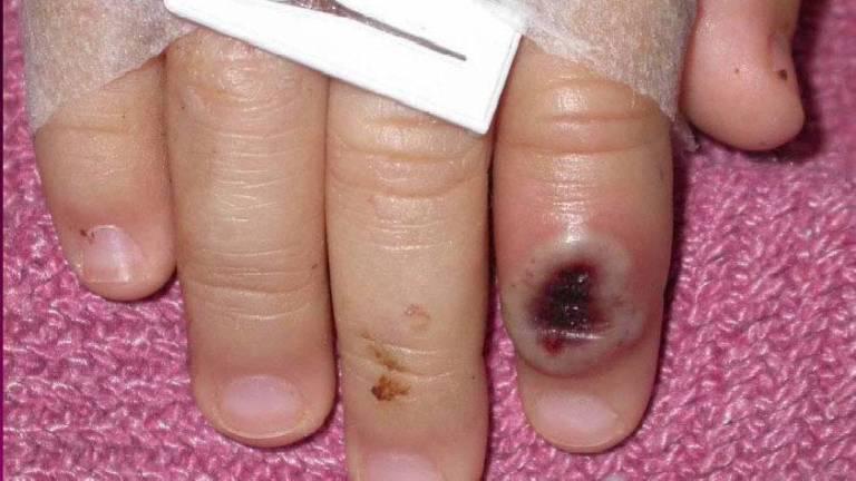 $!Ecuador comprará 2.000 pruebas para detectar la viruela del mono y descarta, por el momento, adquirir vacunas