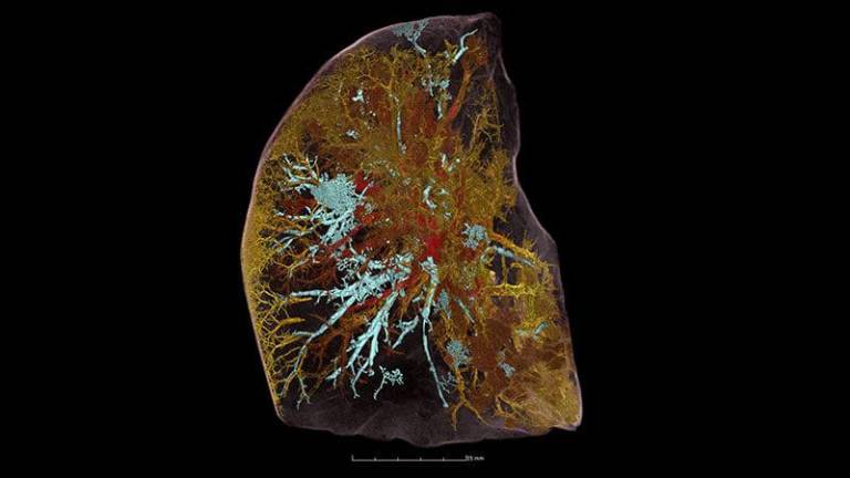 Las radiografías con mayor definición del mundo revelan el daño que la Covid-19 inflige a los pulmones