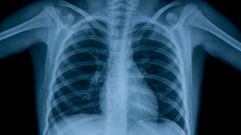 Tuberculosis multirresistente, una amenaza mundial creciente