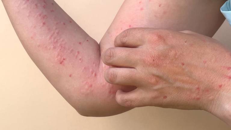 Ascienden a 243 los contagios de viruela del mono a nivel nacional