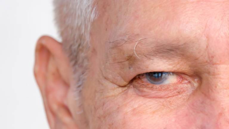 ¿Qué factores incrementa el riesgo de padecer Glaucoma?