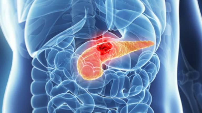 Identifican proteína clave en desarrollo de cáncer de páncreas