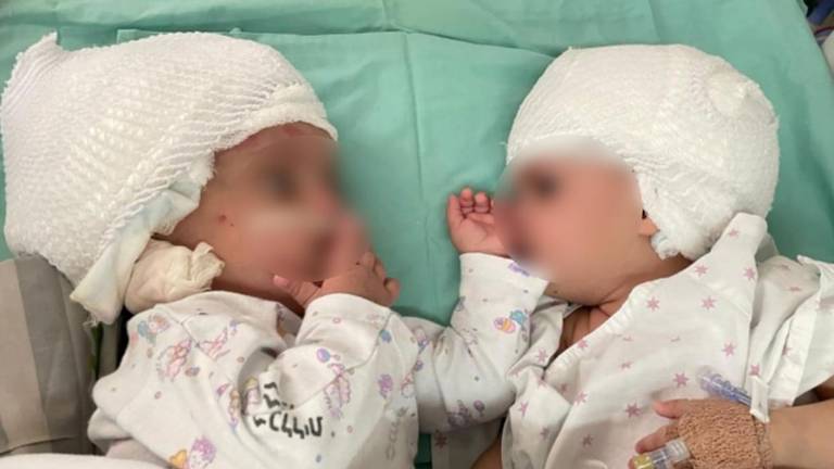 Los gemelos unidos son extremadamente raros.