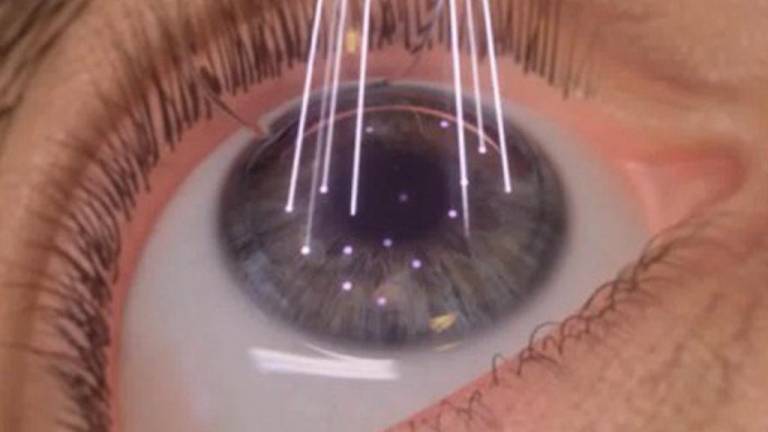 Si estás considerando la cirugía ocular para no tener que usar anteojos o lentes de contacto, estas indicaciones recomendadas por especialistas son fundamentales al momento de decidirte.