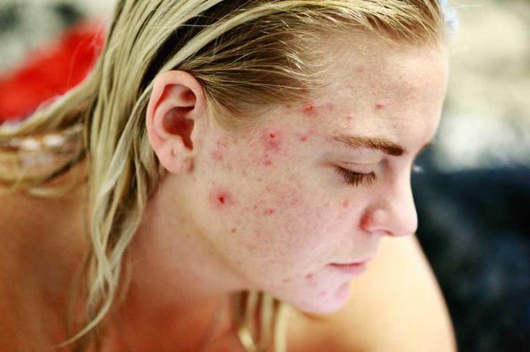 $!El uso de probióticos para la piel, así como en la alimentación, pueden ayudar contra el acné.