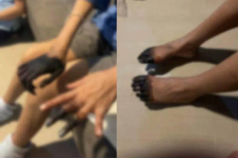 $!Fotografía compartida por el diario tailandés Thaiger en la que se apreciaría el estado de las manos y pies de la paciente.