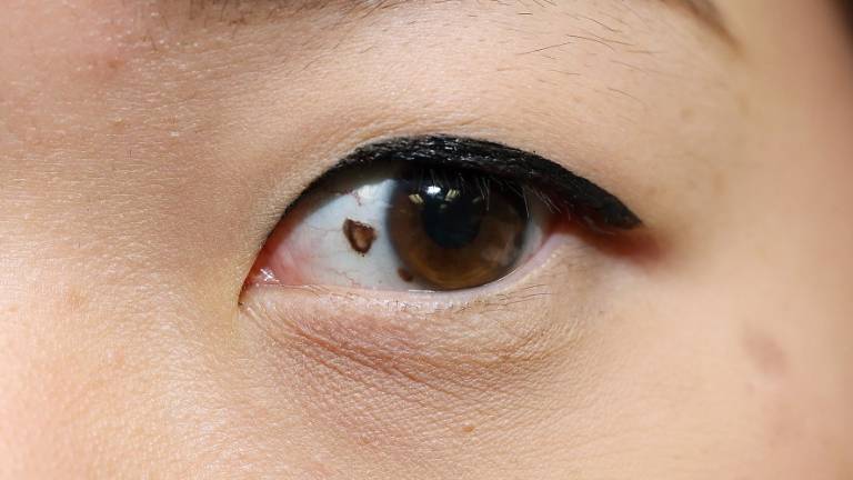 El letal y desconocido cáncer de ojo