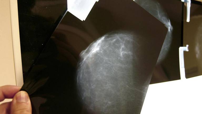 Nuevo fármaco aumenta la supervivencia en pacientes con cáncer de mama metastásico