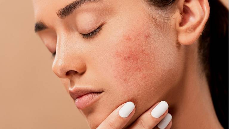 Maquillaje y acné: tipo de cosméticos adecuados para las pieles acneicas
