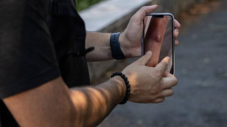 Los peores dolores de mi vida: contagiado con la viruela del mono relata el sufrimiento que causa la enfermedad