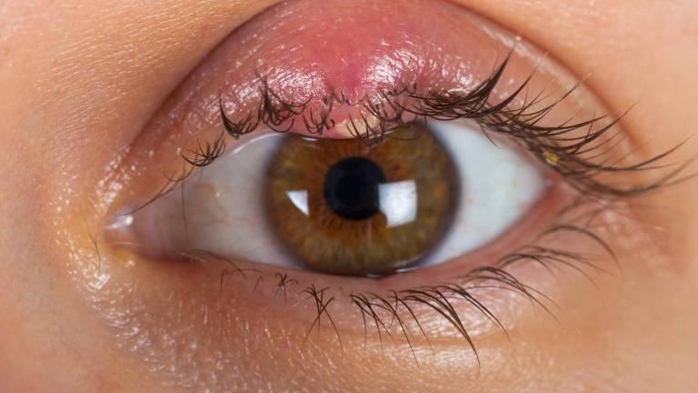 Mujer pensaba que tenía un orzuelo, pero la realidad era más devastadora: Lloré ante la noticia