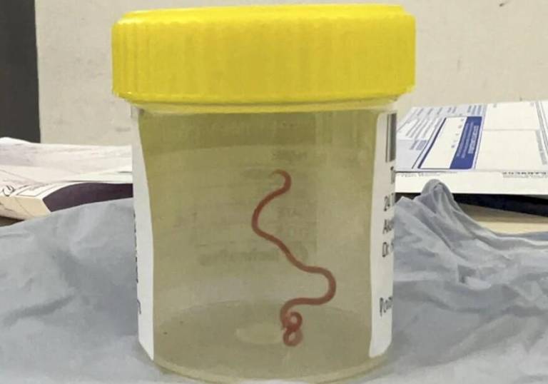 $!Imagen compartido por el cuerpo médico de la lombriz parásita usualmente encontrada en serpientes, esta vez extraída del cerebro de la paciente.