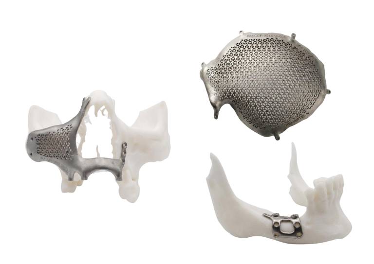 $!Los implantes de Bermart se fabrican con imágenes diagnósticas exactas.