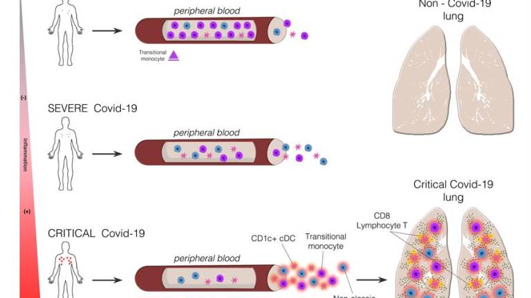 COVID-19 afecta a distintas células del sistema inmunitario según la gravedad