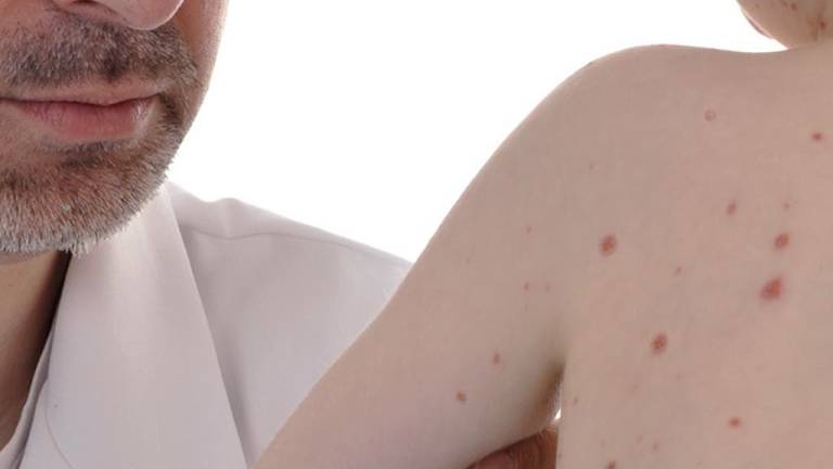 OPS pide vigilancia ante casos de sarampión y recuerda importancia de vacunas