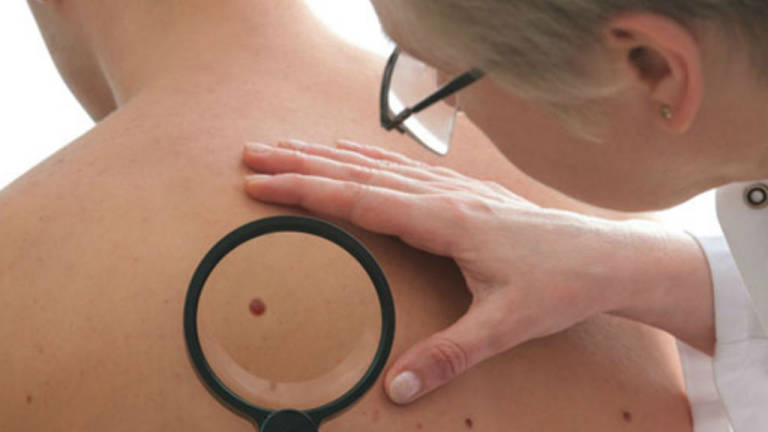 Estudio vincula tratamientos contra la impotencia al cáncer de la piel