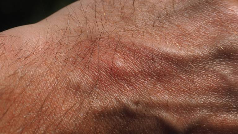 Hallan método para curar heridas sin dejar cicatrices