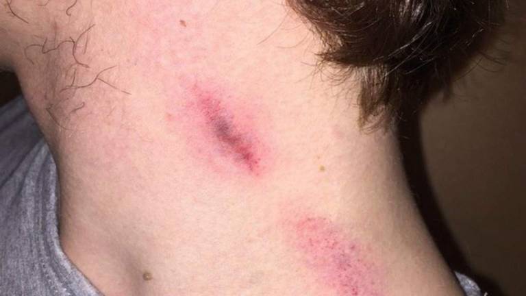 Un &quot;chupetón&quot; en el cuello mata a un joven de 17 años.