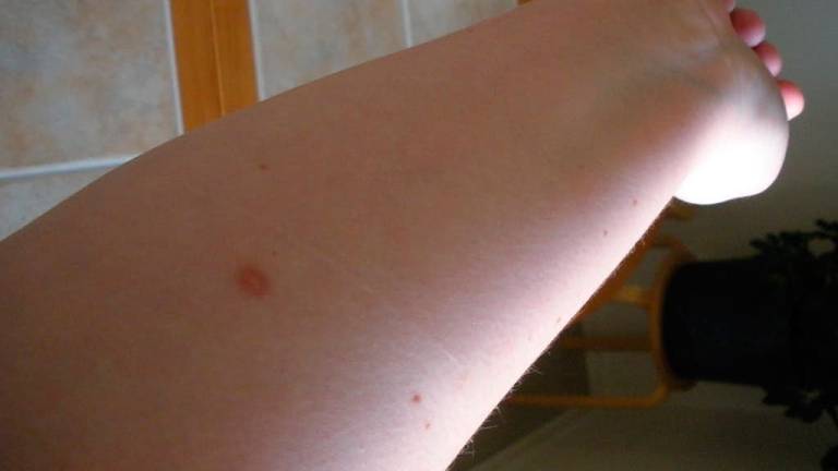Los lunares en el brazo pueden alertar sobre el cáncer de piel