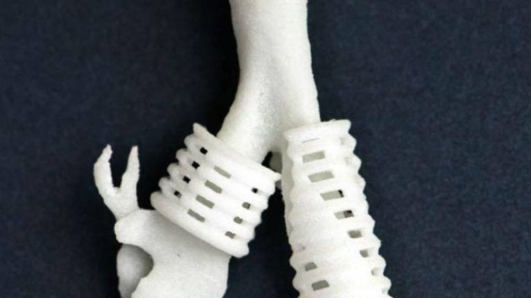Implantes impresos en 3D ayudan a niños con malformación de tráquea