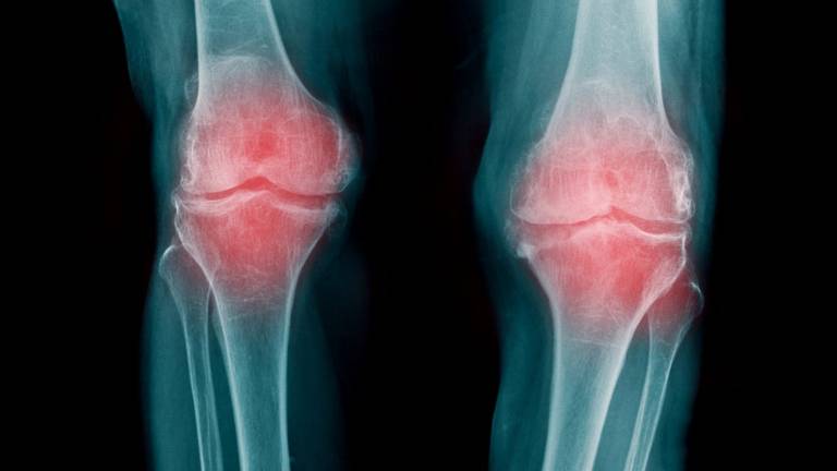 Descubren cómo revertir la artrosis