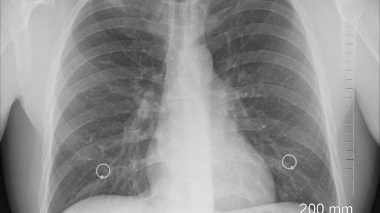 La nueva tecnología que ayuda a detectar más eficazmente el cáncer de pulmón