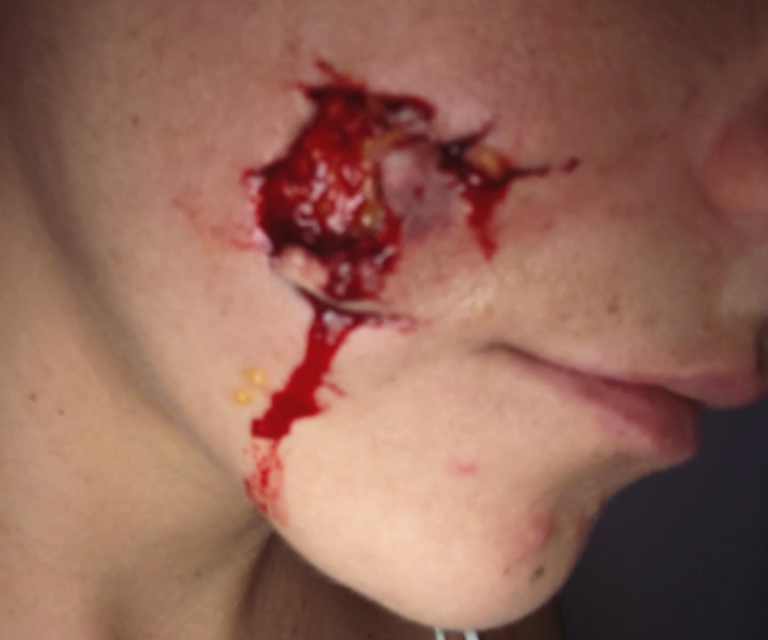 $!Fotografía de la herida que sufrió Nathaly en su mejilla.