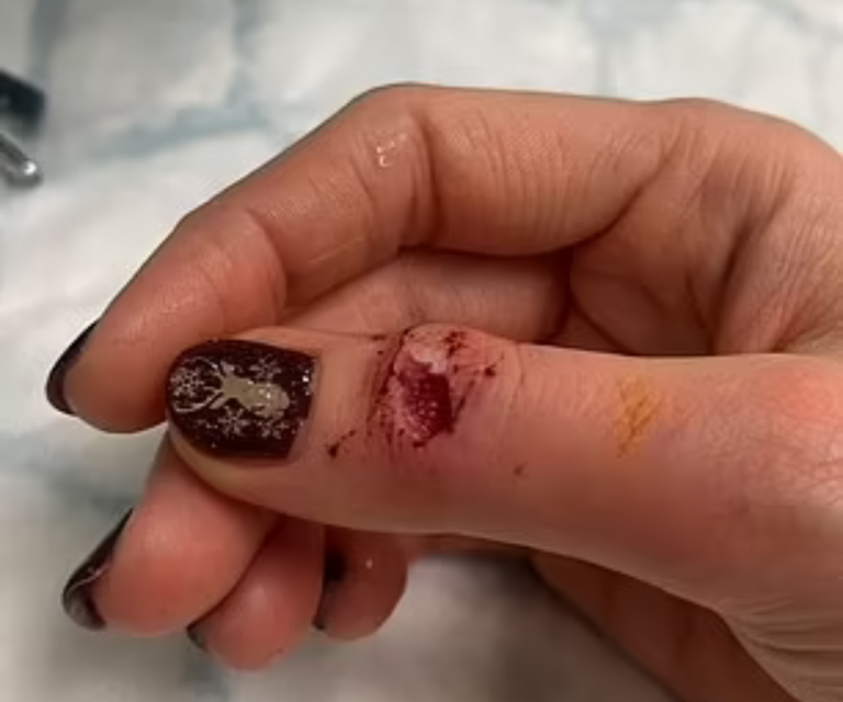 $!Fotografía del dedo pulgar de Nakita tomada tras su arribo al hospital.