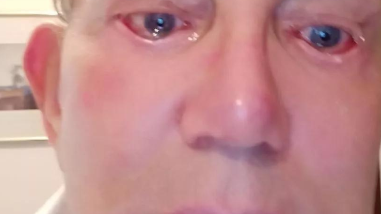 Hombre no pudo cerrar por completo sus ojos durante años tras cirugía fallida para reducir sus mejillas de hámster