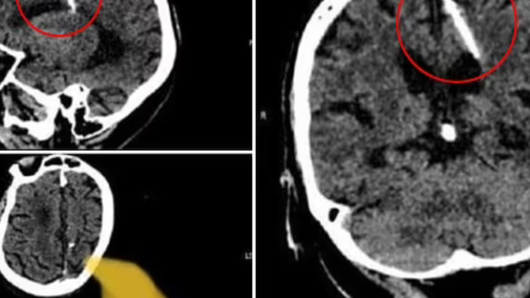 Anciana rusa descubre que ha tenido una aguja enterrada en su cerebro desde que era bebé