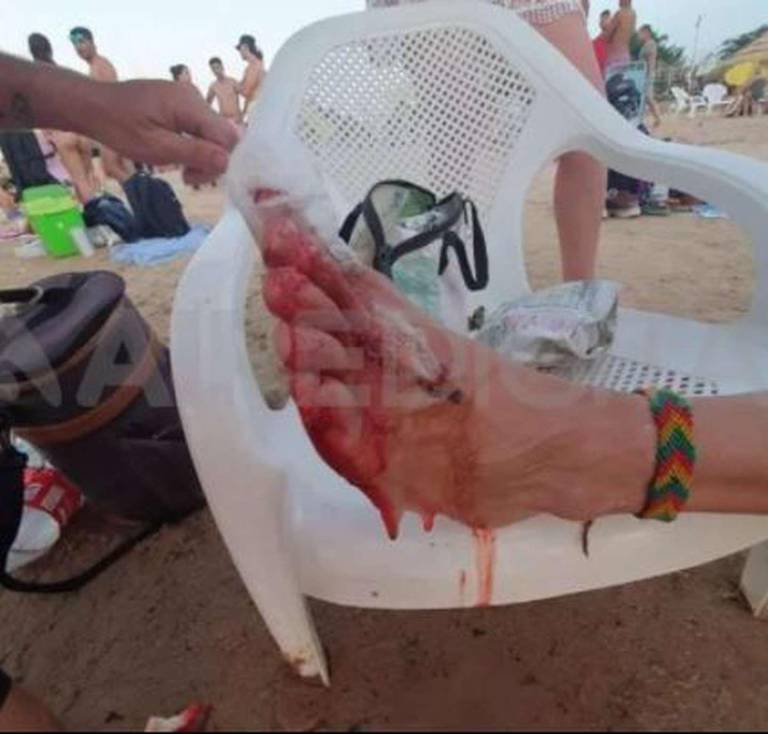 $!Terrorífico ataque de peces carnívoros deja unos 30 heridos en la playa; adolescente perdió un dedo