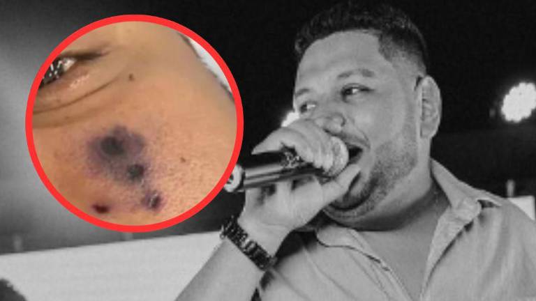 Cantante brasileño habría fallecido por picadura de araña: su rostro empezó a oscurecerse