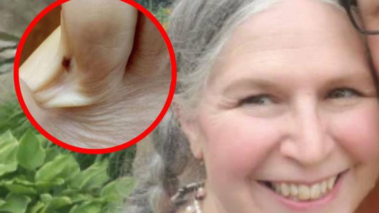 Amy Jardon experimentaba picazón en los dedos de uno de sus pies, pero se escondía un raro cáncer.