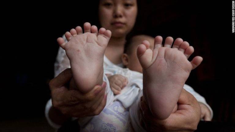 Hong Hong, un bebé chino que nació con 31 dedos