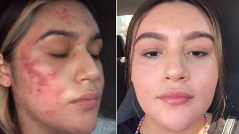 Joven muestra emotivo video de como logró superar un severo caso de acné en TikTok