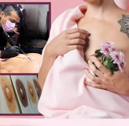 La reconstrucción de areola mamaria restituye la confianza corporal tras el cáncer de mama.